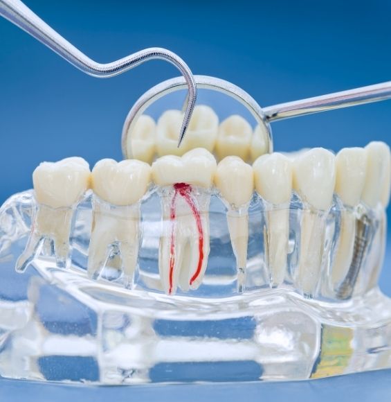 endodoncia en madrid