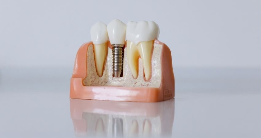 implantes dentales en madrid