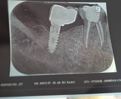 implantes dentales madrid