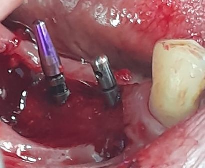 implantologia oral en madrid