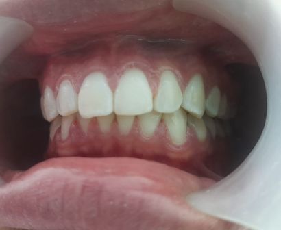 servicio de limpieza dental en madrid