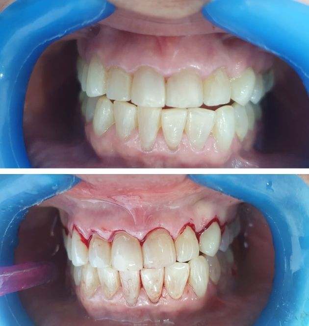 tratamientos de periodoncia en madrid